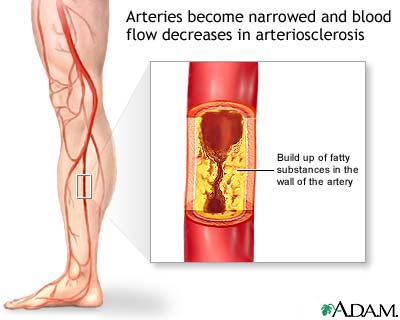 Arteriosclerosis of the extremities