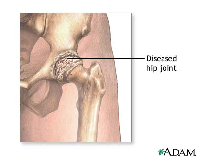 Diseased hip