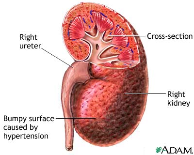 Hypertensive kidney