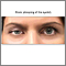 Ptosis, drooping of the eyelid